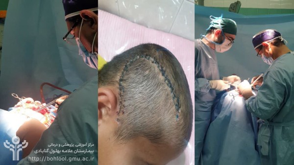 جراحی اورژانسی و موفقیت‌آمیز خونریزی مغزی کودک ۹ ساله در گناباد