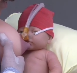 مکیدن پستان CPAP